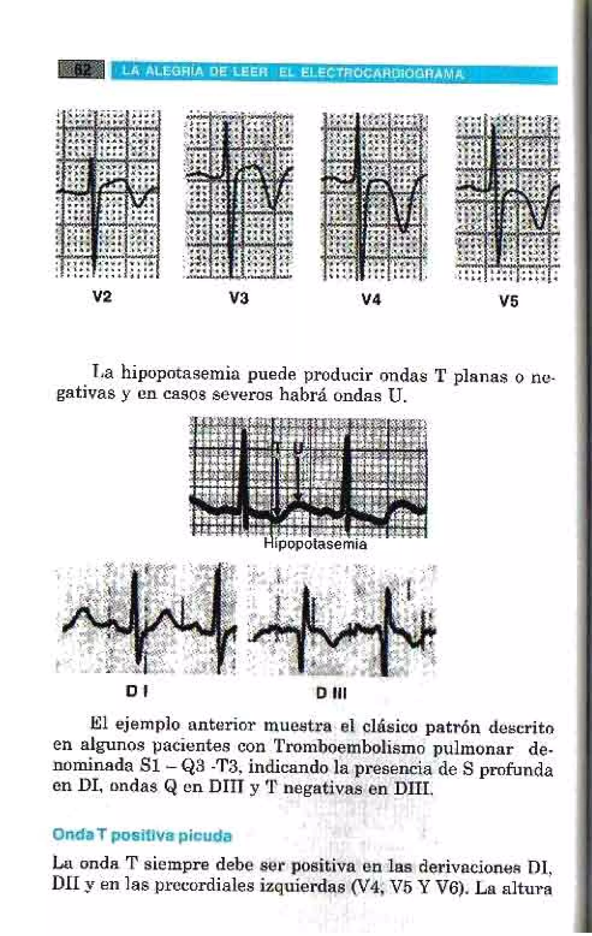 LA ALEGRIA DE LEER EL ELECTROCARDIOGRAMA