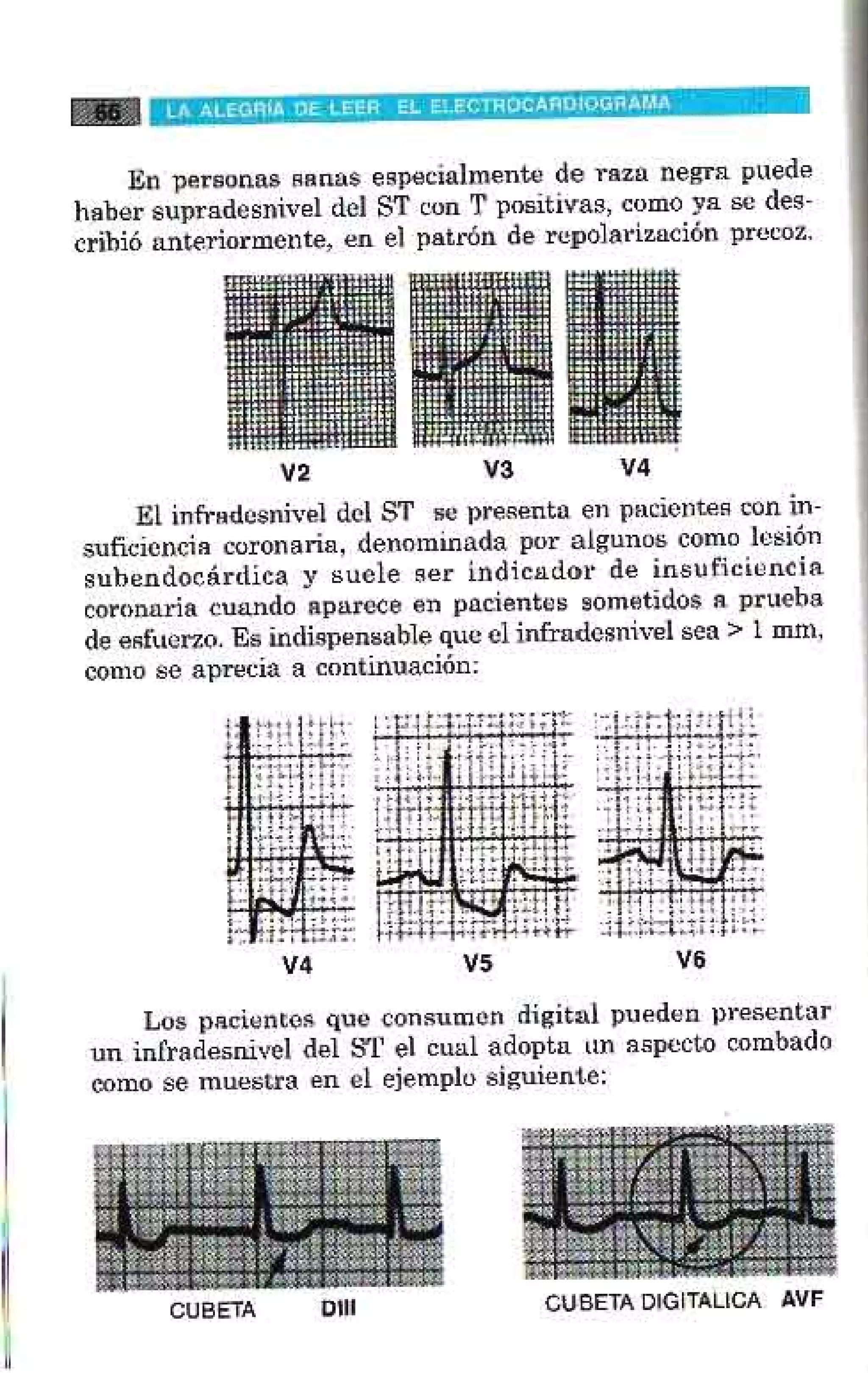 LA ALEGRIA DE LEER EL ELECTROCARDIOGRAMA