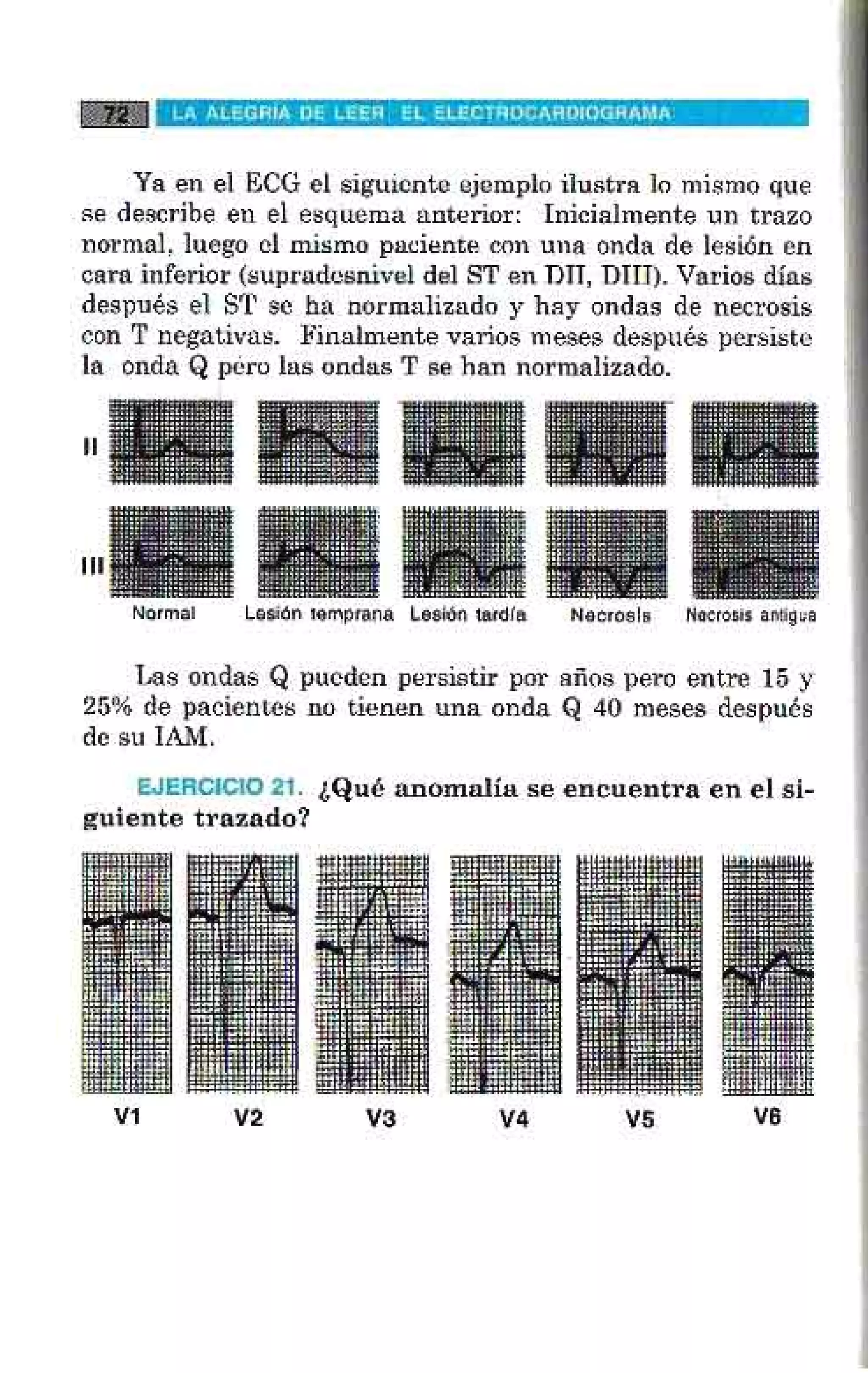 LA ALEGRIA DE LEER EL ELECTROCARDIOGRAMA