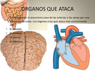 ORGANOS QUE ATACAGeneralmente el aneurisma nace de las arterias o las venas por una dilatación de estas. Los órganos a los que ataca mas comúnmente son:El corazón.El cerebro.La pierna.El intestino.