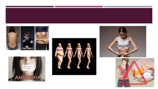 La anorexia presentacion