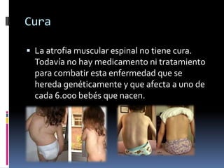 Cura
 La atrofia muscular espinal no tiene cura.
Todavía no hay medicamento ni tratamiento
para combatir esta enfermedad ...
