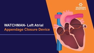 WATCHMAN- Left Atrial
Appendage Closure Device
 