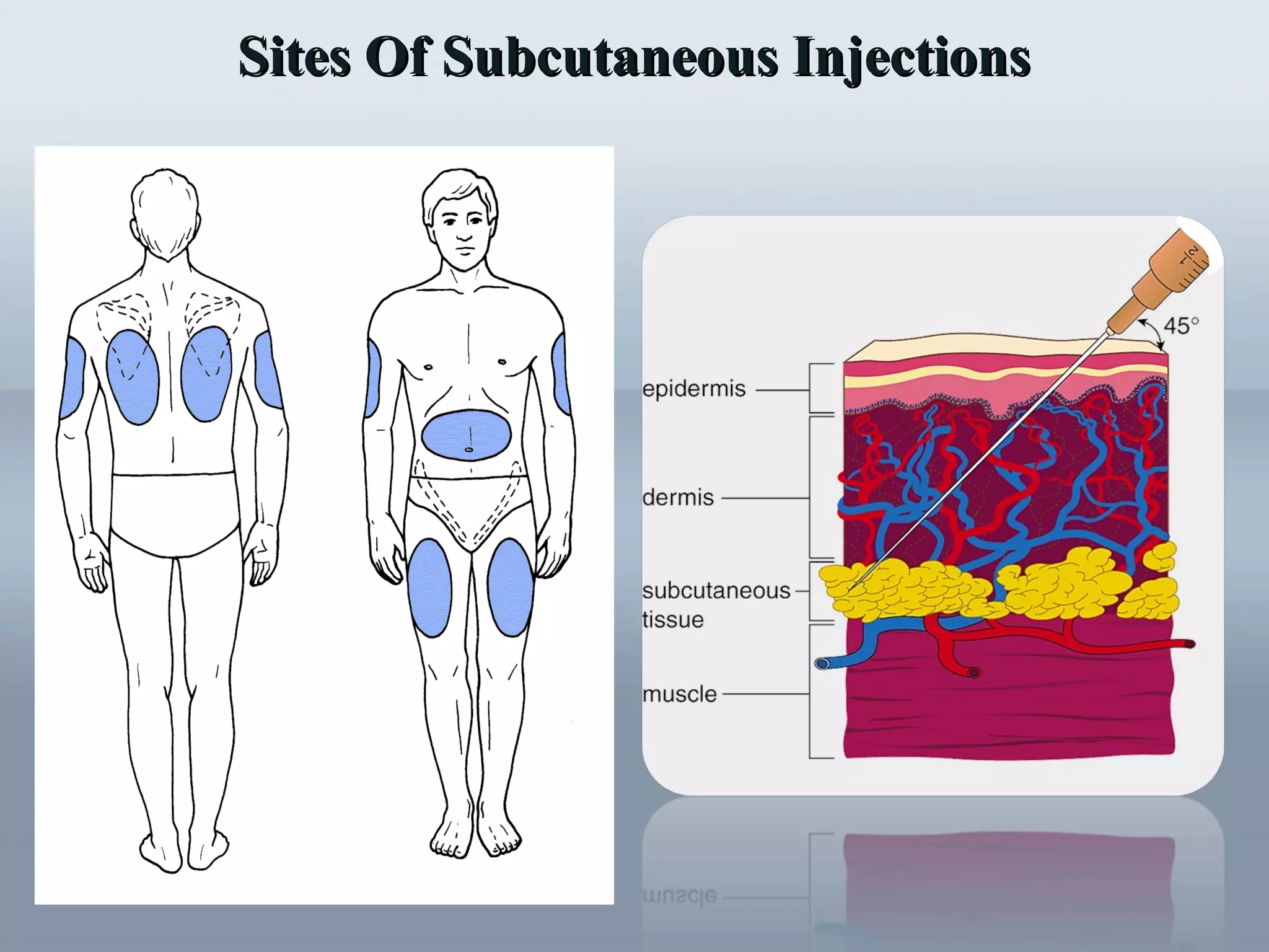 Sites Of Subcutaneous InjectionsSites Of Subcutaneous Injections
 