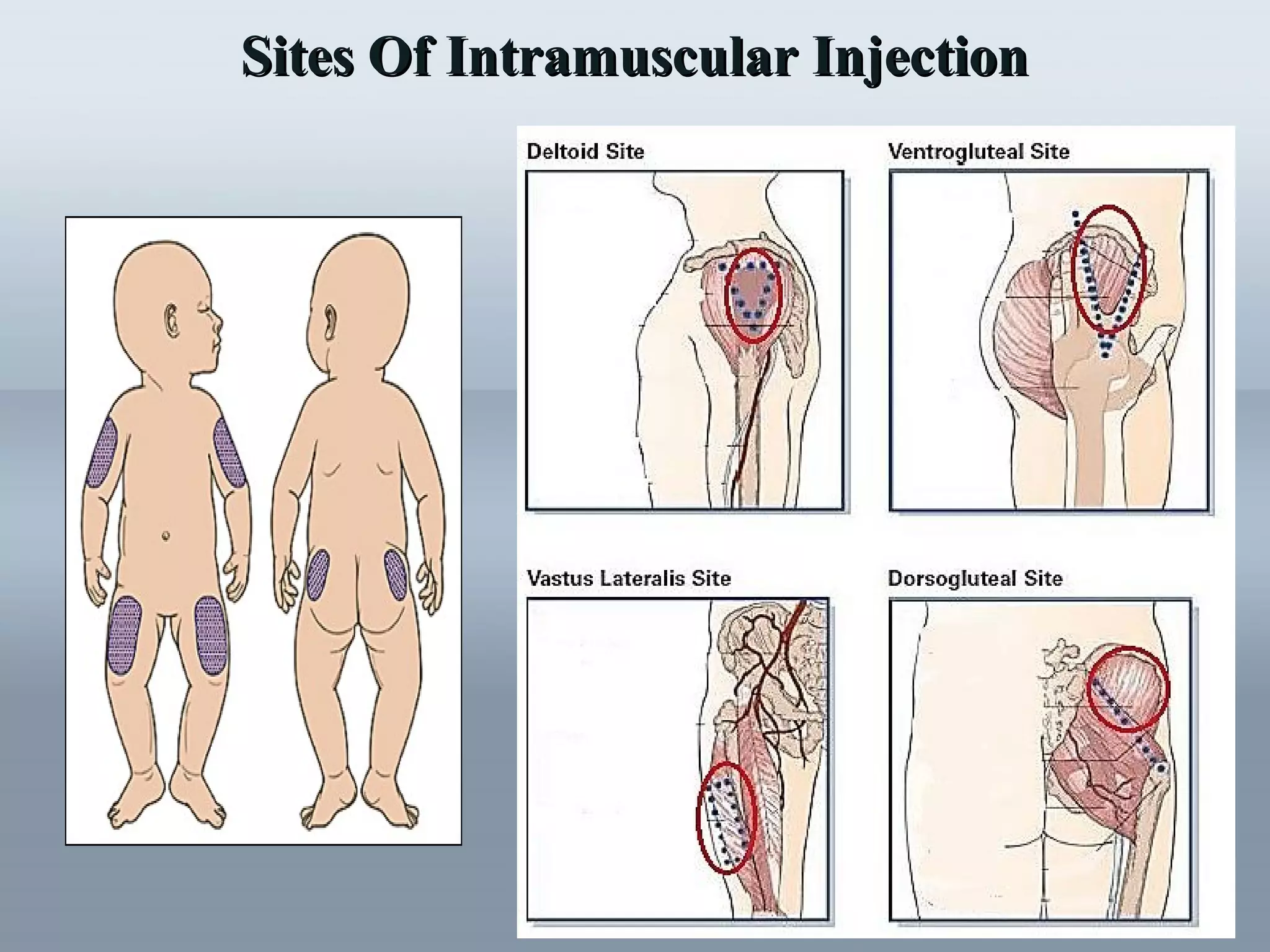 Sites OfSites Of Intramuscular InjectionIntramuscular Injection
 