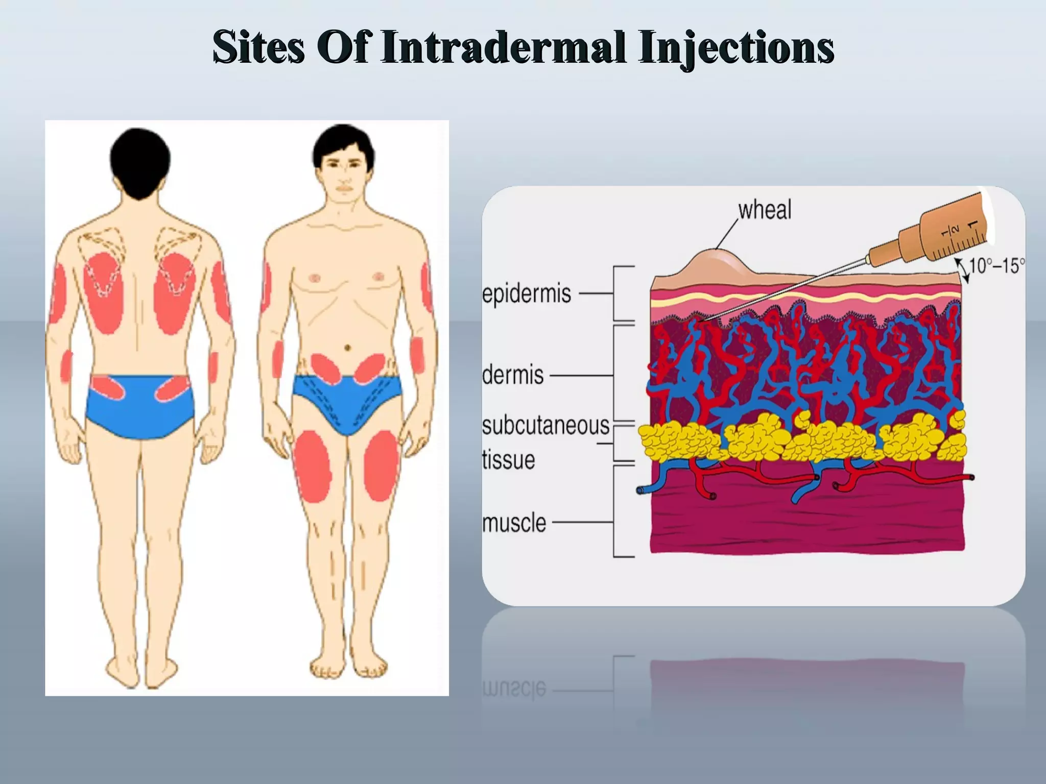 Sites Of Intradermal InjectionsSites Of Intradermal Injections
 