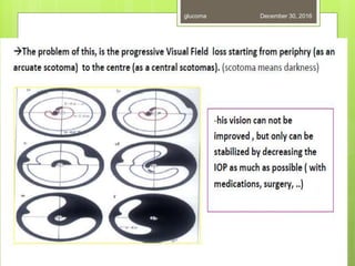 December 30, 2016glucoma
 