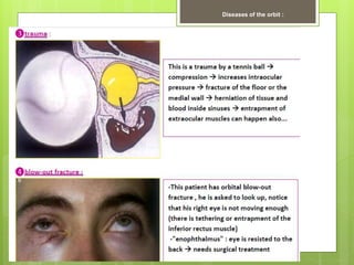 Diseases of the orbit :
 