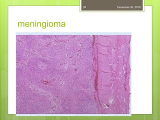 meningioma
December 30, 201639
 