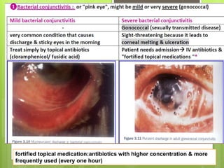 December 30, 20164
fortified topical medication:antibiotics with higher concentration & more
frequently used (every one hour)
 