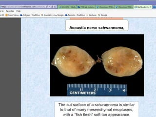 December 30, 201650
Acoustic nerve schwannoma,
 