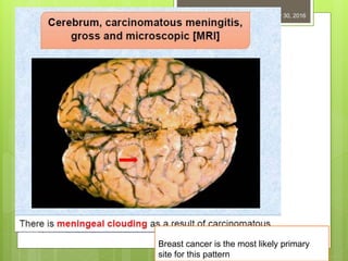 December 30, 201667
Breast cancer is the most likely primary
site for this pattern
 