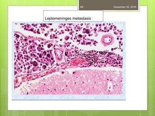 December 30, 201668
Leptomeninges metastasis
 