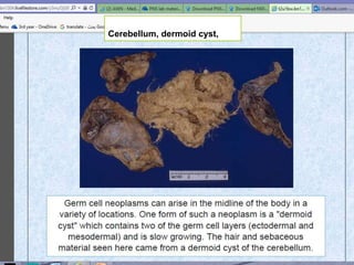 December 30, 201669
Cerebellum, dermoid cyst,
 