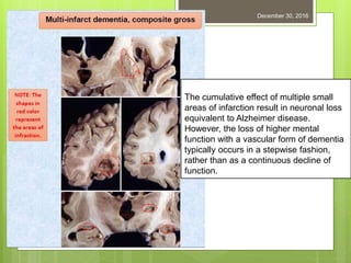 December 30, 201683
The cumulative effect of multiple small
areas of infarction result in neuronal loss
equivalent to Alzheimer disease.
However, the loss of higher mental
function with a vascular form of dementia
typically occurs in a stepwise fashion,
rather than as a continuous decline of
function.
 