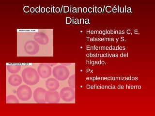 Codocito/Dianocito/Célula
         Diana
             • Hemoglobinas C, E,
               Talasemia y S.
             • Enfermedades
               obstructivas del
               hígado.
             • Px
               esplenectomizados
             • Deficiencia de hierro
 