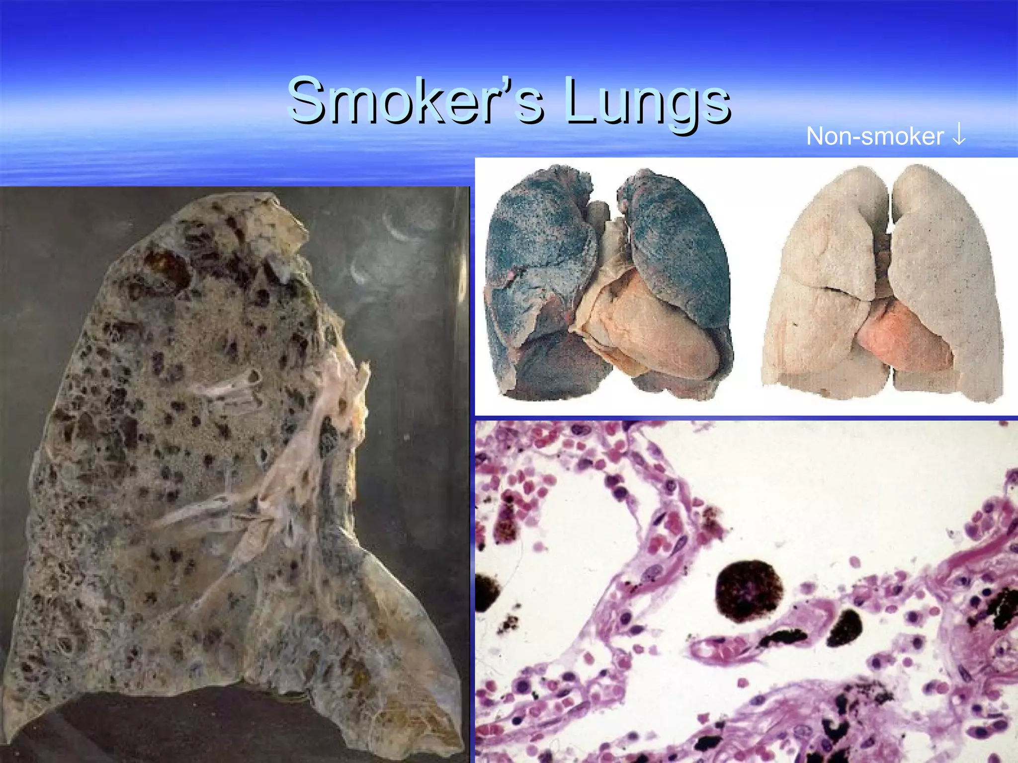 Smoker’s Lungs Non-smoker   