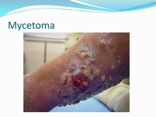 Mycetoma
 