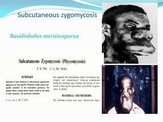 Subcutaneous zygomycosis
Basidiobolus meristosporus
 