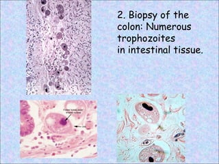 2. Biopsy of the colon: Numerous trophozoites in intestinal tissue.  