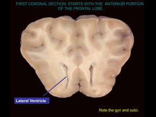 Lateral Ventricle
Note the gyri and sulci.
FIRST CORONAL SECTION: STARTS WITH THE ANTERIOR PORTION
OF THE FRONTAL LOBE
 