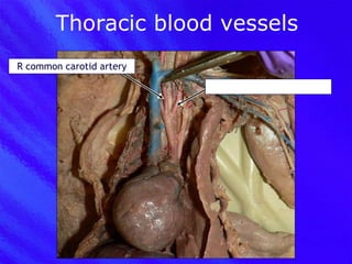 Thoracic blood vessels R common carotid artery L common carotid artery 