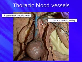 Thoracic blood vessels R common carotid artery L common carotid artery 