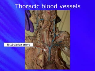 Thoracic blood vessels R subclavian artery 