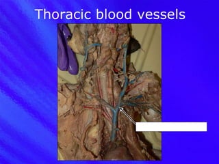 Thoracic blood vessels Left braciocephalic vein 