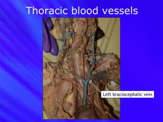 Thoracic blood vessels Left braciocephalic vein 