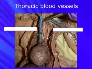 Thoracic blood vessels Brachiocephalic artery Left subclavian artery 