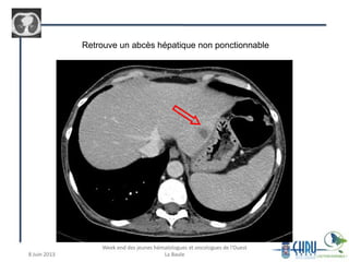 Retrouve un abcès hépatique non ponctionnable
 