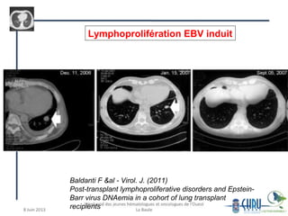 Baldanti F &al - Virol. J. (2011)
Post-transplant lymphoproliferative disorders and Epstein-
Barr virus DNAemia in a cohort of lung transplant
recipients
Lymphoprolifération EBV induit
 