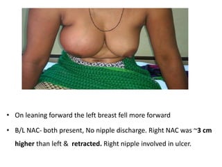 • On leaning forward the left breast fell more forward
• B/L NAC- both present, No nipple discharge. Right NAC was ~3 cm
higher than left & retracted. Right nipple involved in ulcer.
 