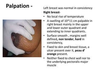 Palpation - Left breast was normal in consistency
Right breast-
• No local rise of temperature
• A swelling of 10*11 cm palpable in
right breast mainly in the upper
and lower outer quadrant and
extending to inner quadrants.
• Surface smooth , margins well
defined, non tender, hard in
consistency,
• Fixed to skin and breast tissue, a
ulcer present over it, peau d’
orange present.
• Neither fixed to chest wall nor to
the underlying pectoralis major
muscle
 