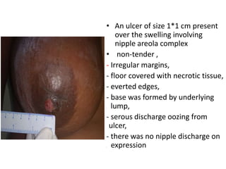 • An ulcer of size 1*1 cm present
over the swelling involving
nipple areola complex
• non-tender ,
- Irregular margins,
- floor covered with necrotic tissue,
- everted edges,
- base was formed by underlying
. lump,
- serous discharge oozing from
….ulcer,
- there was no nipple discharge on
. expression
 