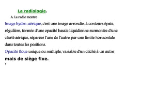 La radiologie.
A. La radio montre
Image hydro-aérique, c'est une image arrondie, à contours épais,
régulière, formée d'une opacité basale liquidienne surmontée d'une
clarté aérique, séparées l'une de l'autre par une limite horizontale
dans toutes les positions.
Opacité floue unique ou multiple, variable d'un cliché à un autre
mais de siège fixe.
•
 