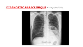 DIAGNOSTIC PARACLINIQUE la radiographie montre
 