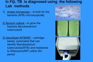 Lab Genetics Tuberculosis Lab component of dx tb | PPT