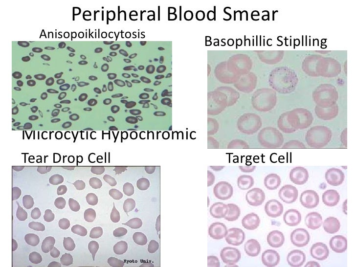 LabORATORY daigonosis thalassemia Chirantan Man