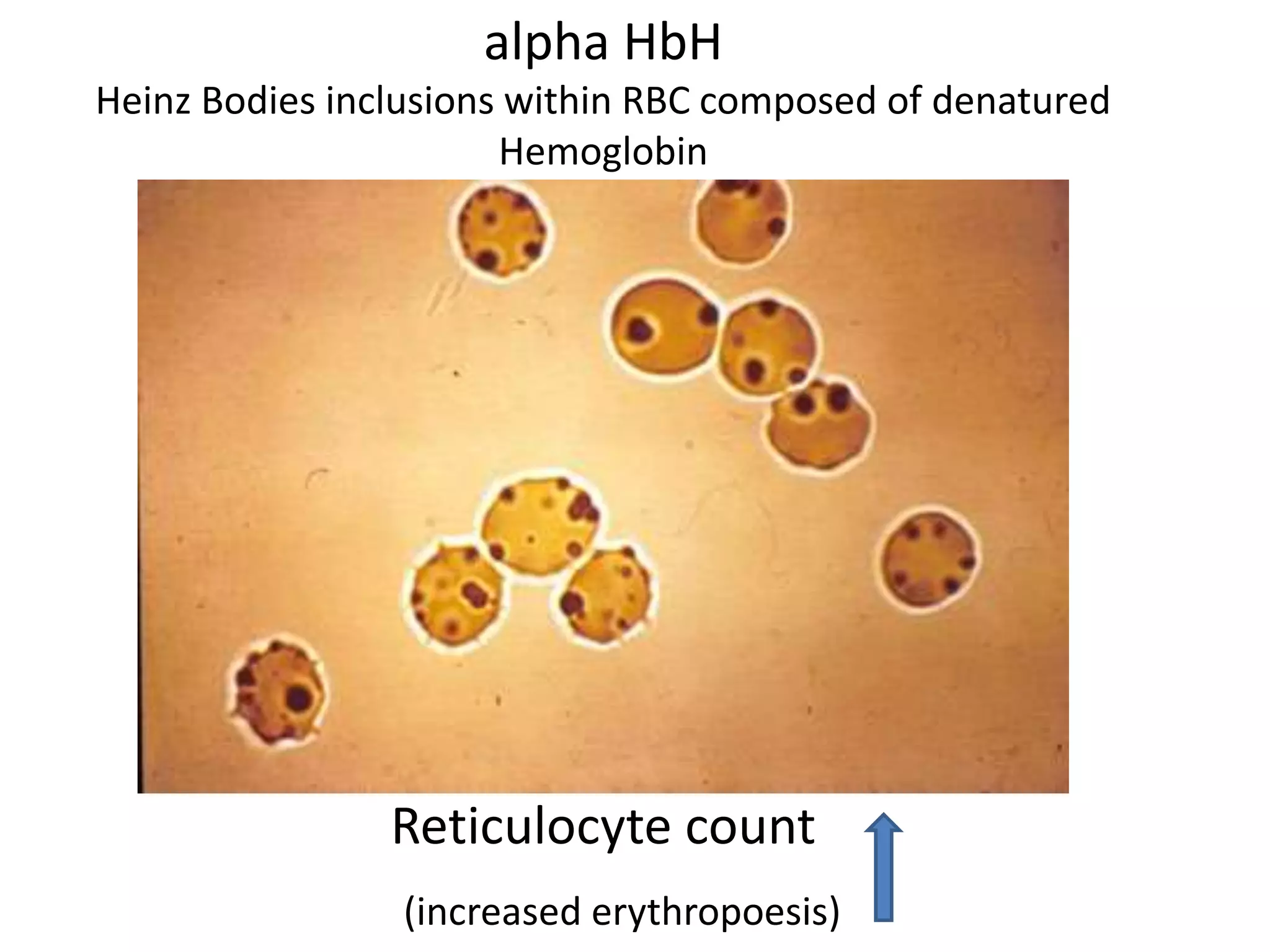 Laboratory Diagonosis thalassemia Chirantan | PPTX