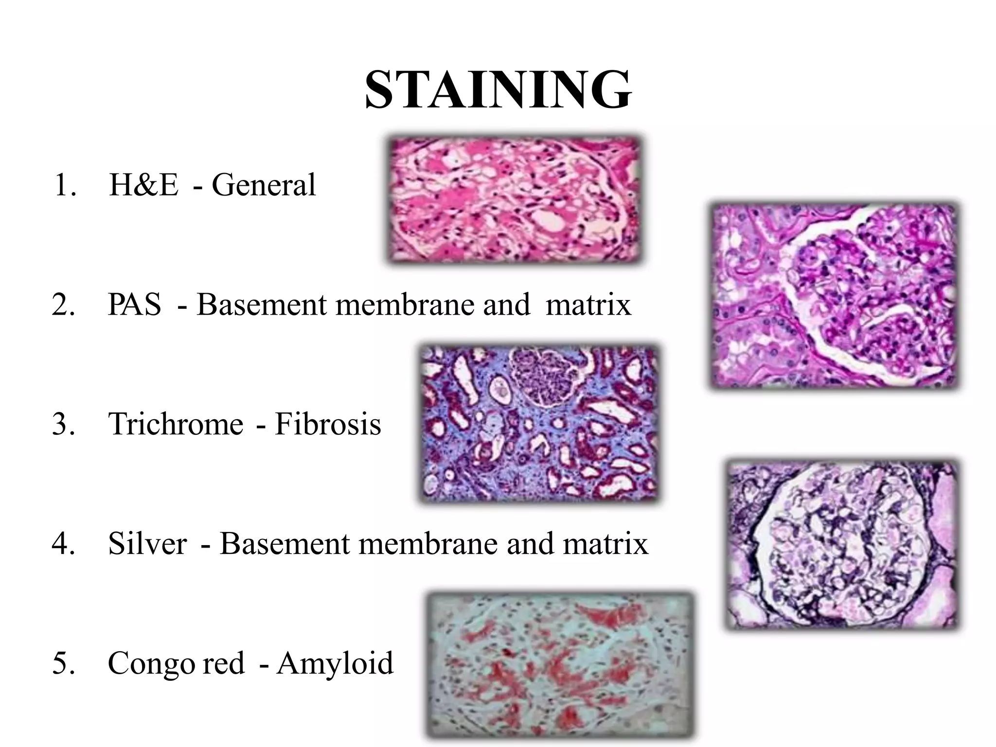 1. H&E - General
2. PAS - Basement membrane and matrix
3. Trichrome - Fibrosis
4. Silver - Basement membrane and matrix
5. Congo red - Amyloid
STAINING
 