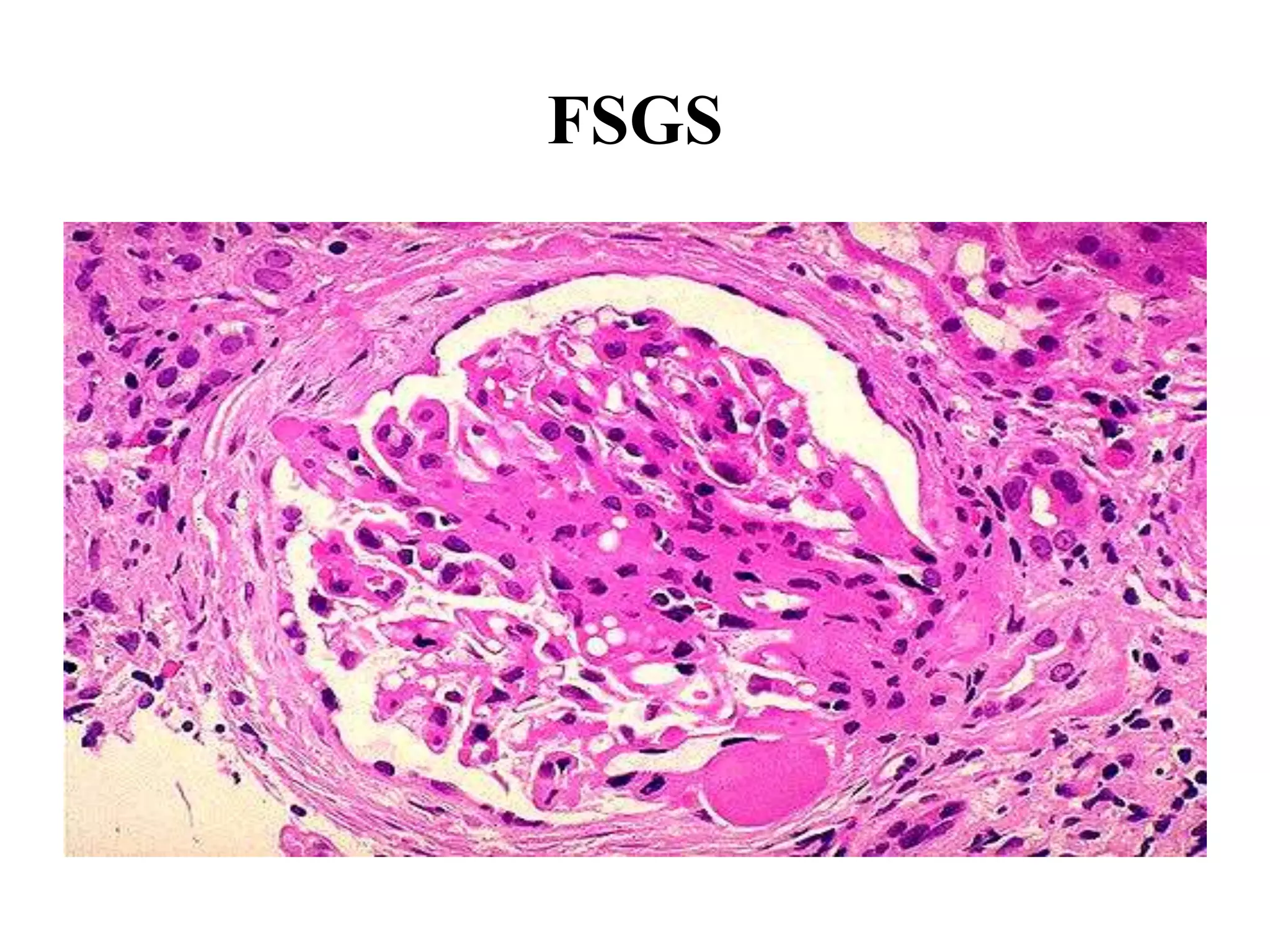 FSGS
 