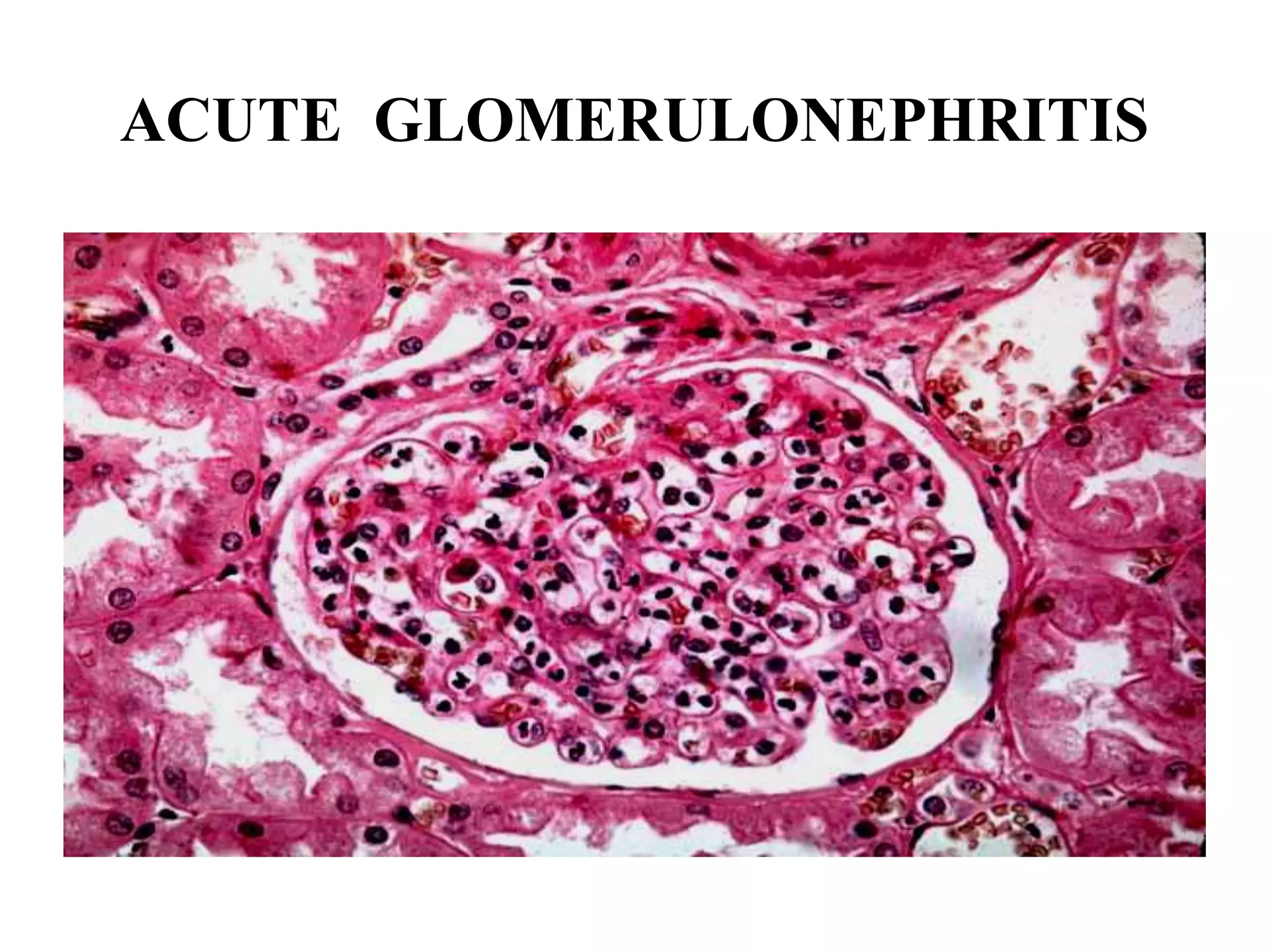 ACUTE GLOMERULONEPHRITIS
 