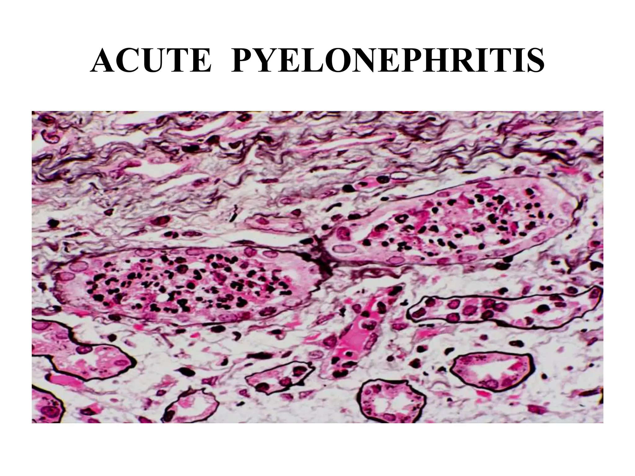 ACUTE PYELONEPHRITIS
 