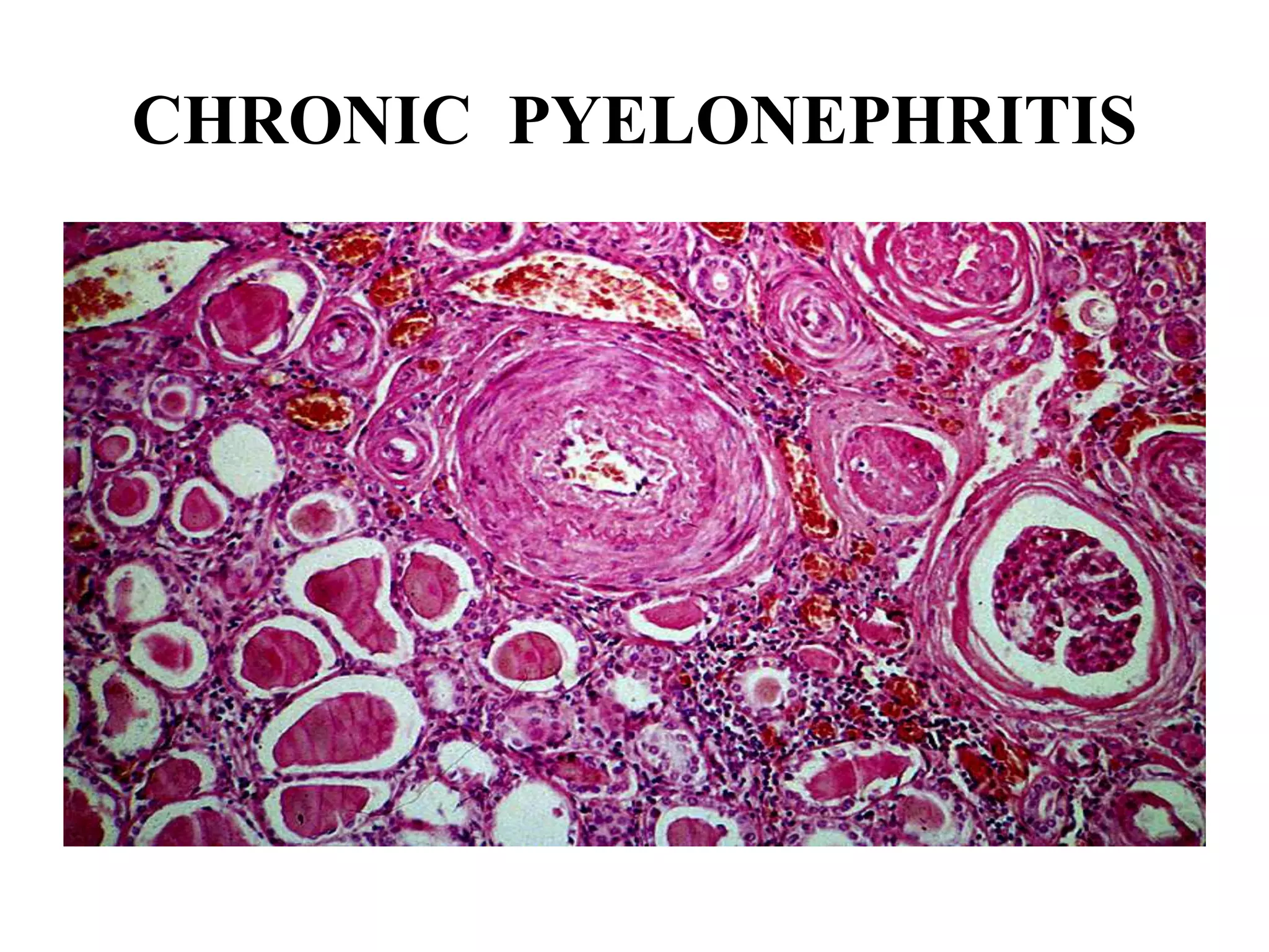 CHRONIC PYELONEPHRITIS
 