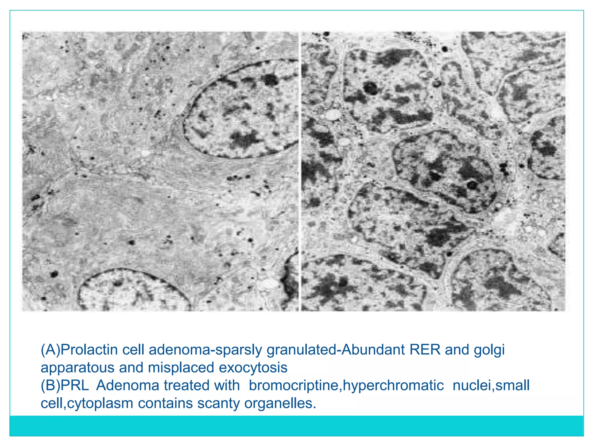 Lab diagnosis of pituitary tumors | PPTX