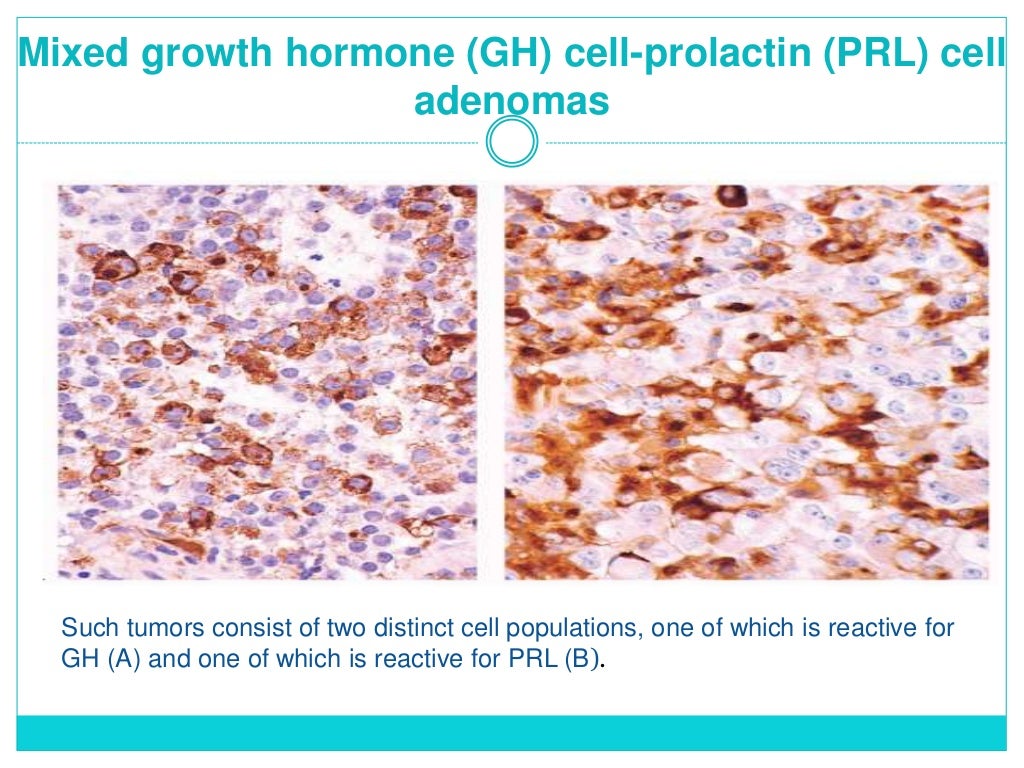 Lab diagnosis of pituitary tumors