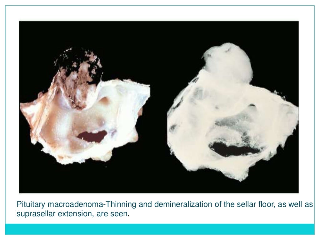 Lab diagnosis of pituitary tumors