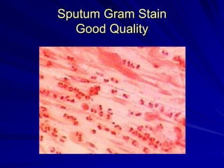 Sputum Gram Stain
Good Quality
 